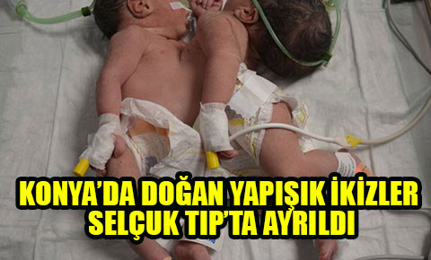 Konya’da doğan yapışık ikizler Selçuk Tıp’ta ayrıldı