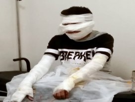 Torpil patlatan çocuklar yandı