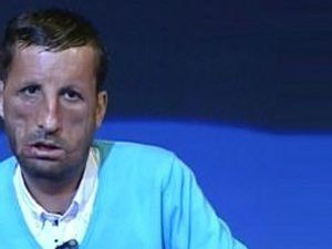 Uğur Acara yapılan yüz naklinin bedeli