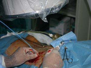 Bu ameliyat yöntemi kanamayı azaltıyor